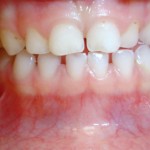Ortodoncia Preventiva En Niños 3