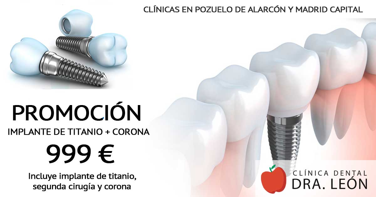 promoción implantes dentales Madrid